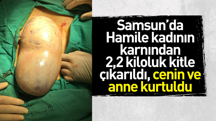 Samsun'da hamile kadının karnından 2,2 kiloluk kitle çıkarıldı, cenin ve anne kurtuldu