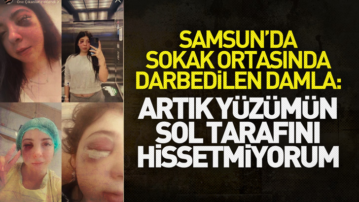 Samsun'da sokak ortasında darbedilen Damla: Artık yüzümün sol tarafını hissetmiyorum